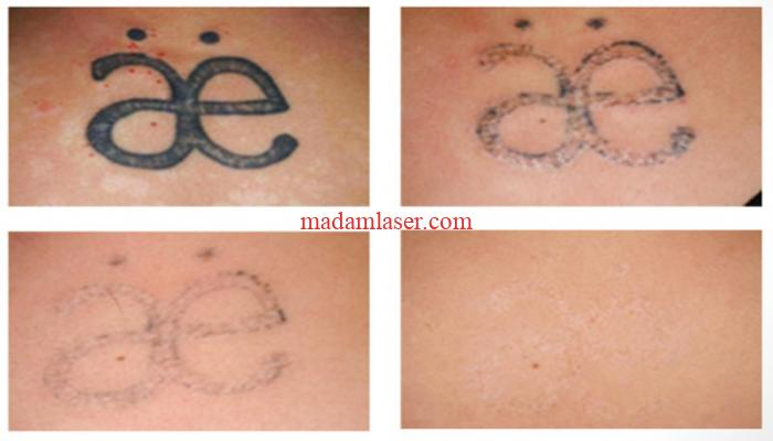 پاک کردن تاتو با لیزر