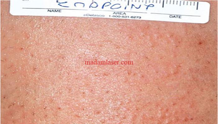 علت جوش زدن بعد از لیزر موهای زائد