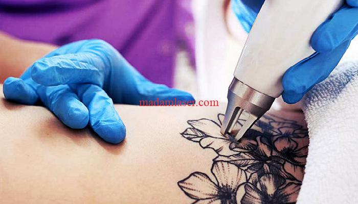 مراقبت های بعد از پاک کردن تاتو با لیزر