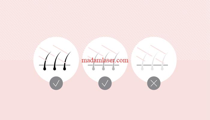 چه افرادی مناسب لیزر موهای زائد نیستند؟