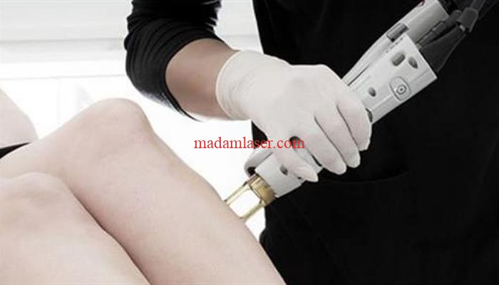 آیا با لیزر موهای زائد بیکینی پوست واژن سفید می شود؟