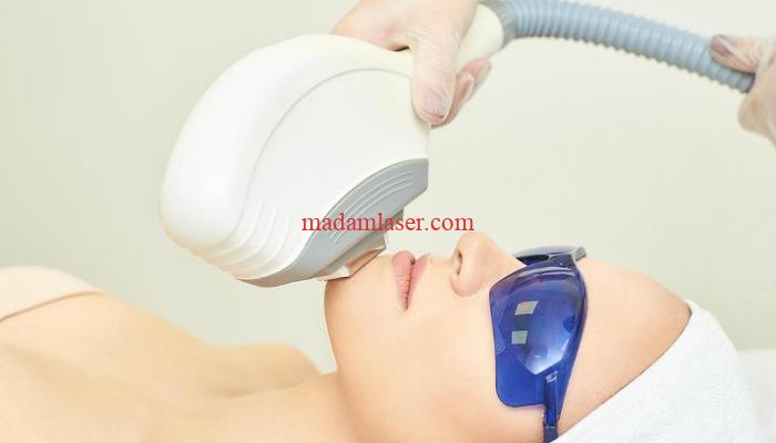 رفع موهای زاید صورت