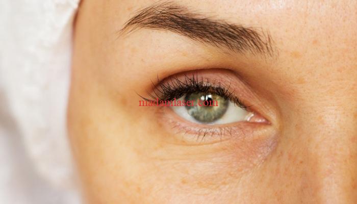 تاثیر لیزر رادو پلاس در کاهش چین و چروک