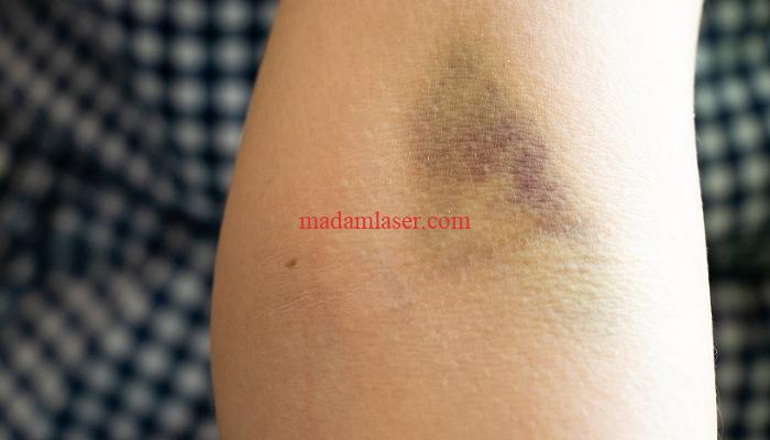 تاثیر نور لیزر در رنگ پوست و جلوگیری از کبودی پس از لیزر موهای زائد