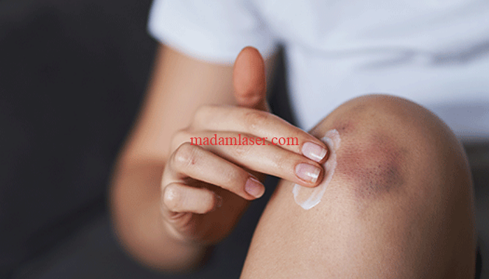 تاثیر رژیم غذایی مناسب در کاهش کبودی پس از لیزر موهای زائد